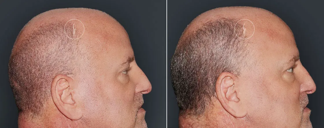 RF Microneedling Before and After