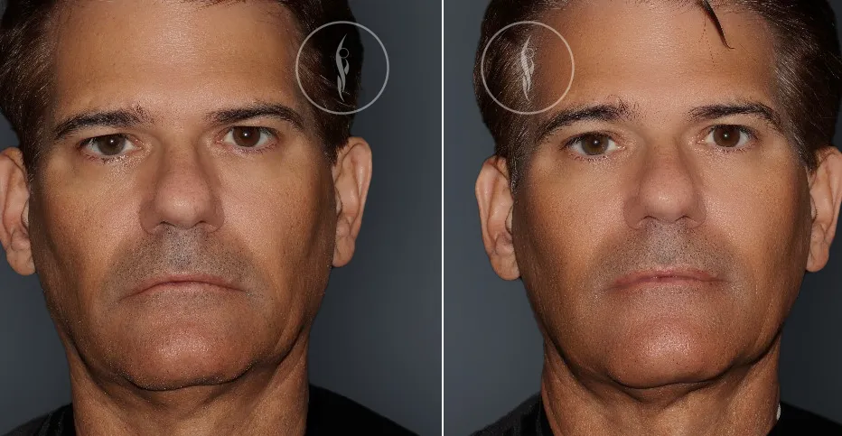 Ultherapy Non Surgical Facelift Results