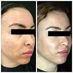 HALO Treatment Results