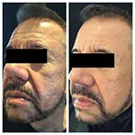 HALO Treatment Results