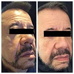 HALO Treatment Results