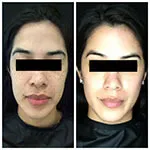 HALO Treatment Results