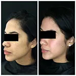 HALO Treatment Results