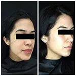 HALO Treatment Results