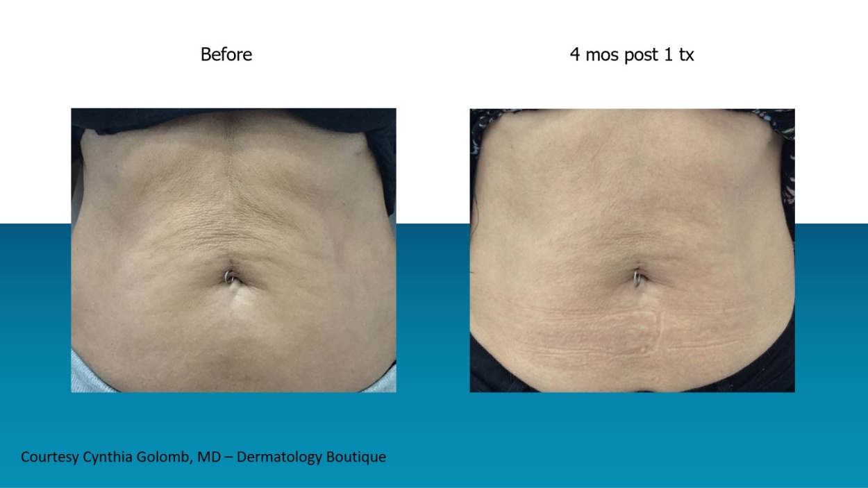 RF Microneedling for Stretch Marks? How Does it Work? - Smooth