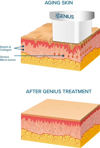 Genius RF Needling Illustration %city% %state%