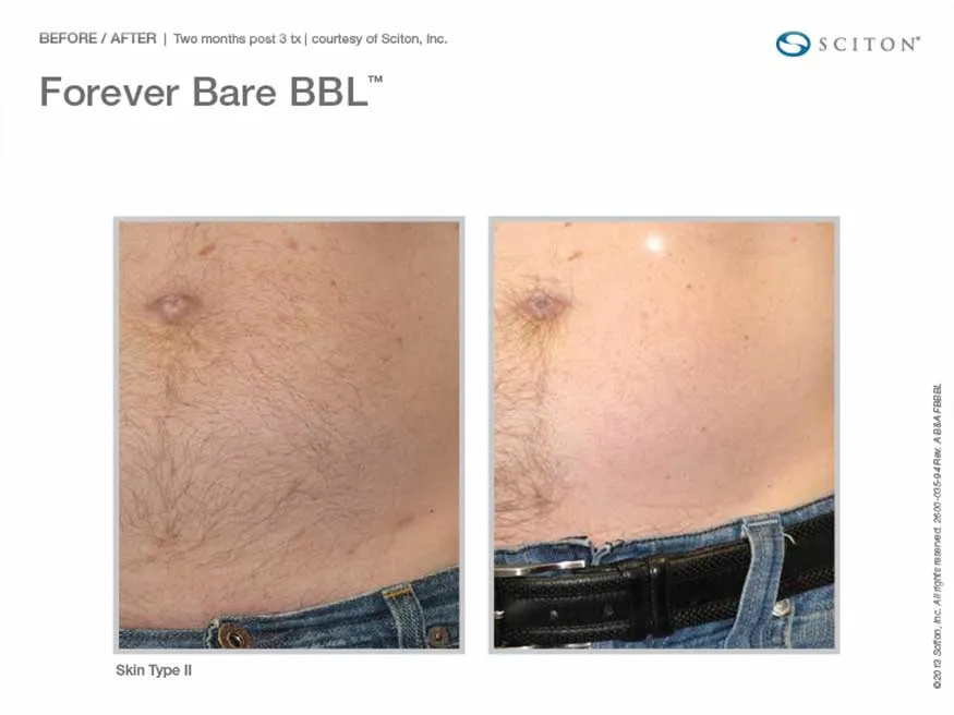 Forever Bare BBL Laser Hair Removal Fort Lauderdale